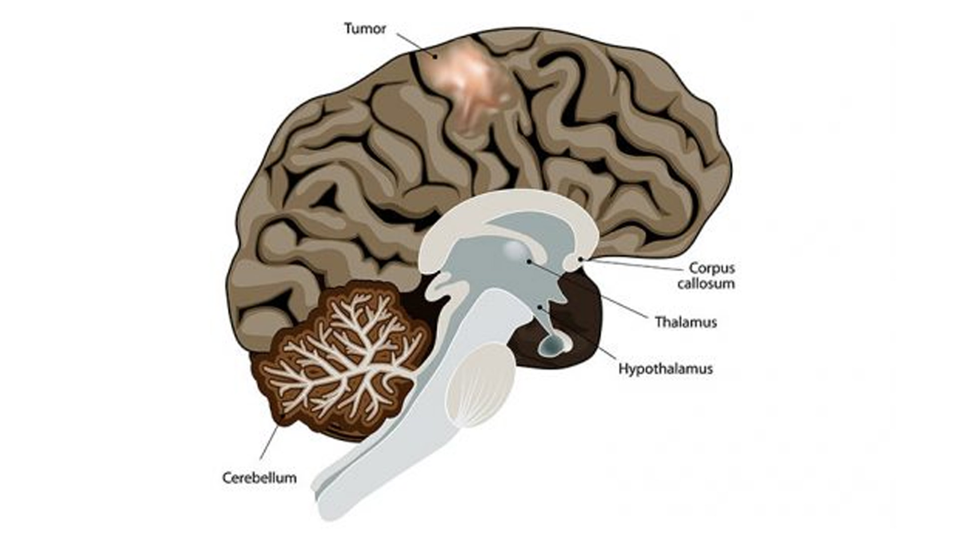 После 40 головного мозга. Головной мозг при болезни Паркинсона. Болезнь Паркинсона мозг. Новообразование в головном мозге.