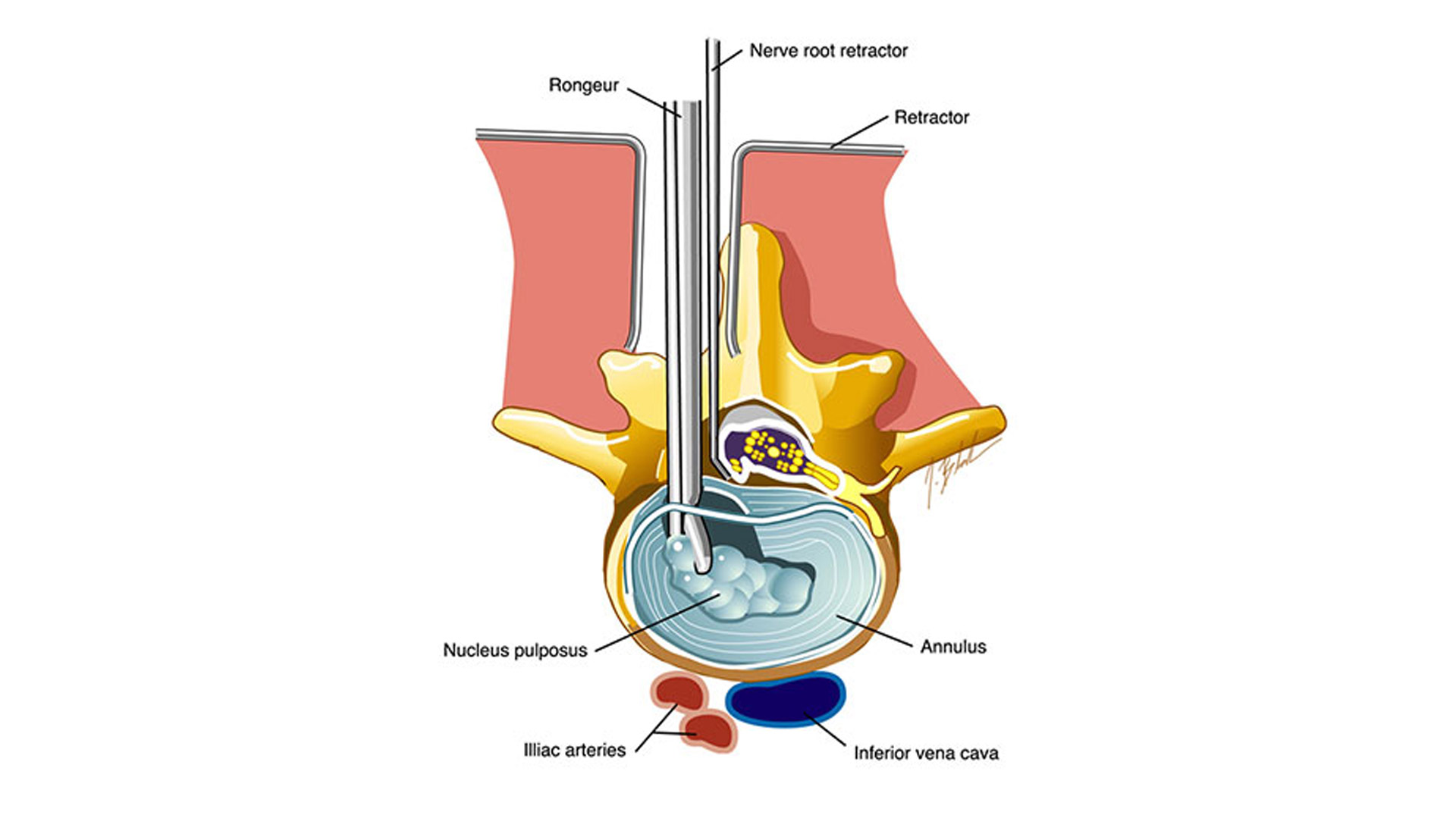 Derrico nerve root retractor